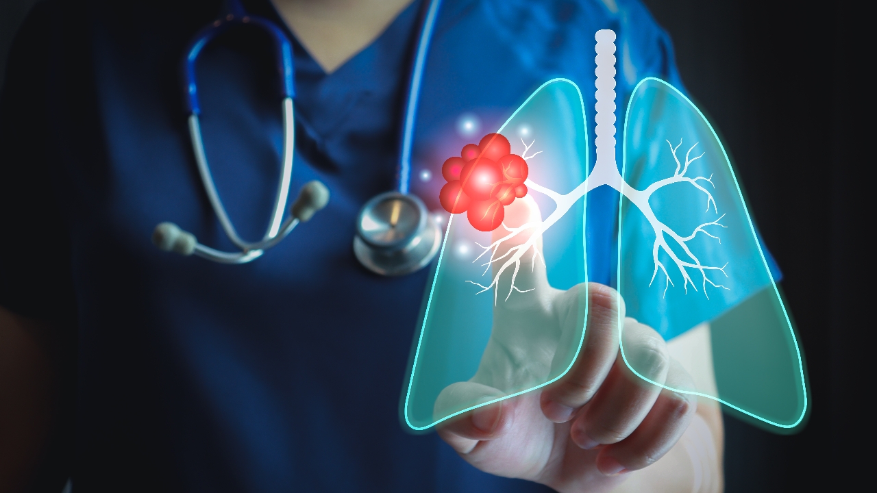 คาดการณ์ปี 68 "มะเร็งปอด" กลายเป็นภัยร้ายอันดับ 1 คร่าชีวิต 41 คนต่อวัน