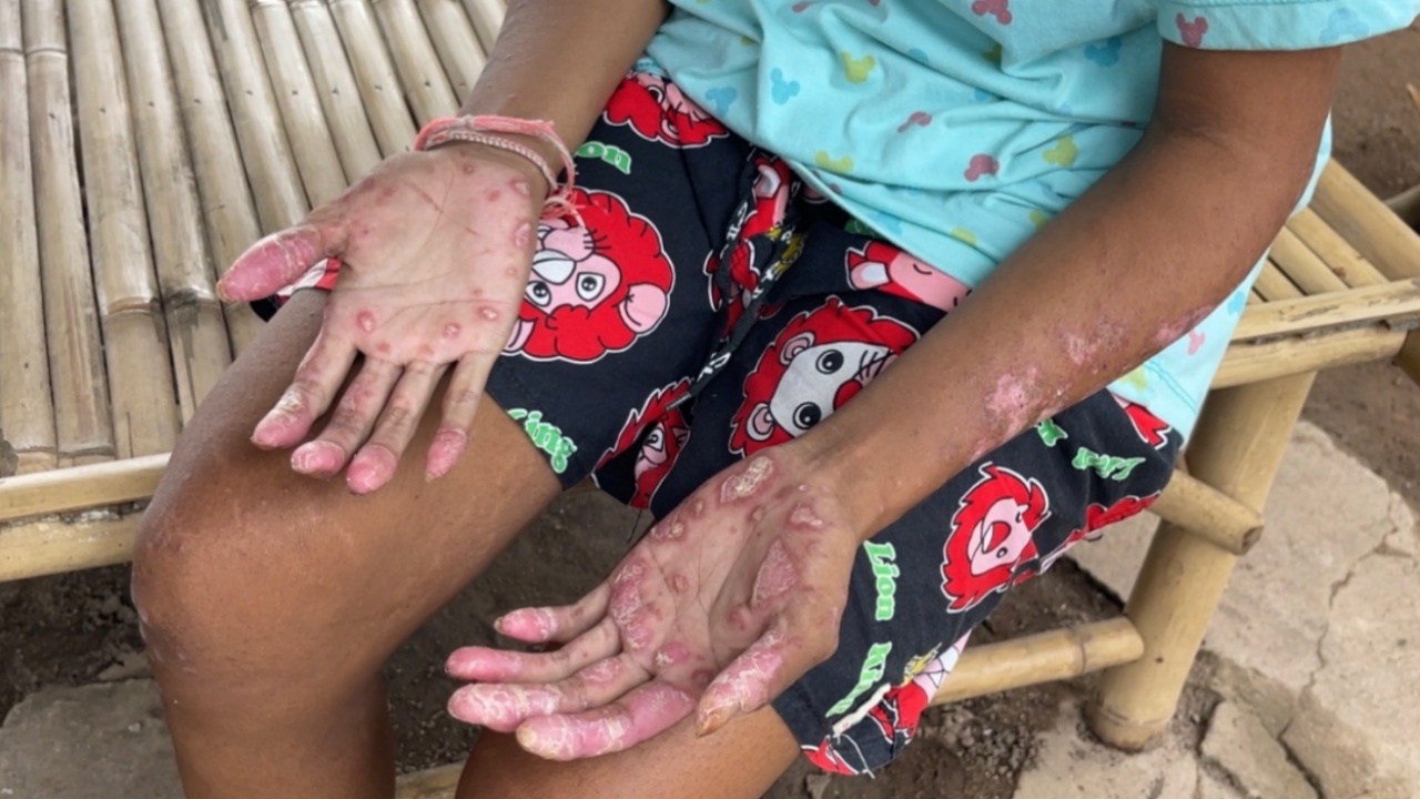 สาวป่วยมีแผลเรื้อรัง ทุกข์ทรมานมากว่า 3 ปี อยากไปรักษากับ ดร.เฉลิมพล