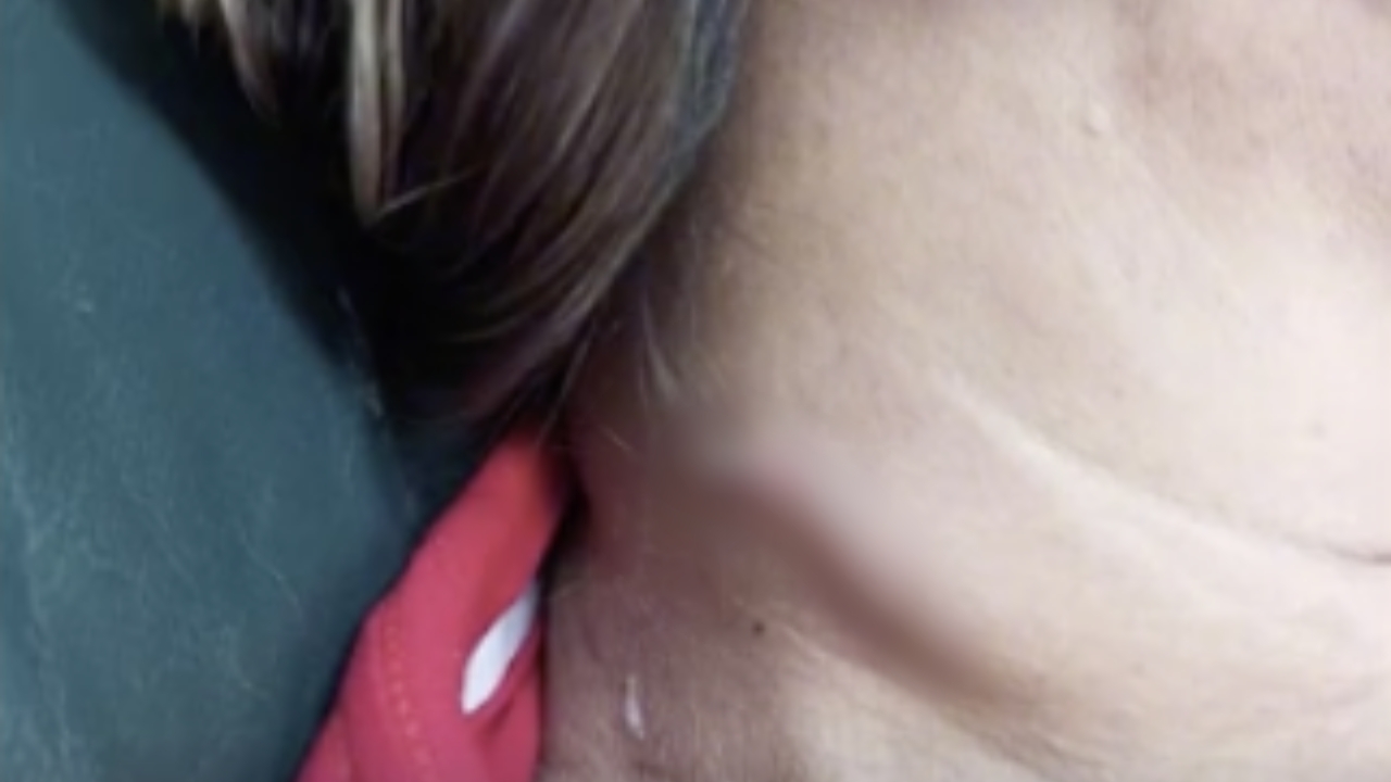 กินปลาต้องระวัง หนุ่มใหญ่แชร์อุทาหรณ์ "ก้างปลา" ติดคอภรรยา จนทะลุออกมาด้านนอก