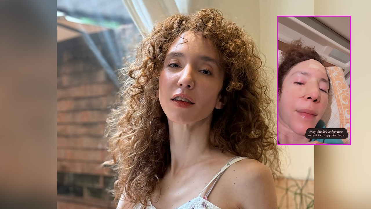 คลาวเดีย จักรพันธ์ุ เปิดภาพใบหน้า หลังเกิดอาการวูบล้มหน้าฟาดพื้น เย็บ 35 เข็ม