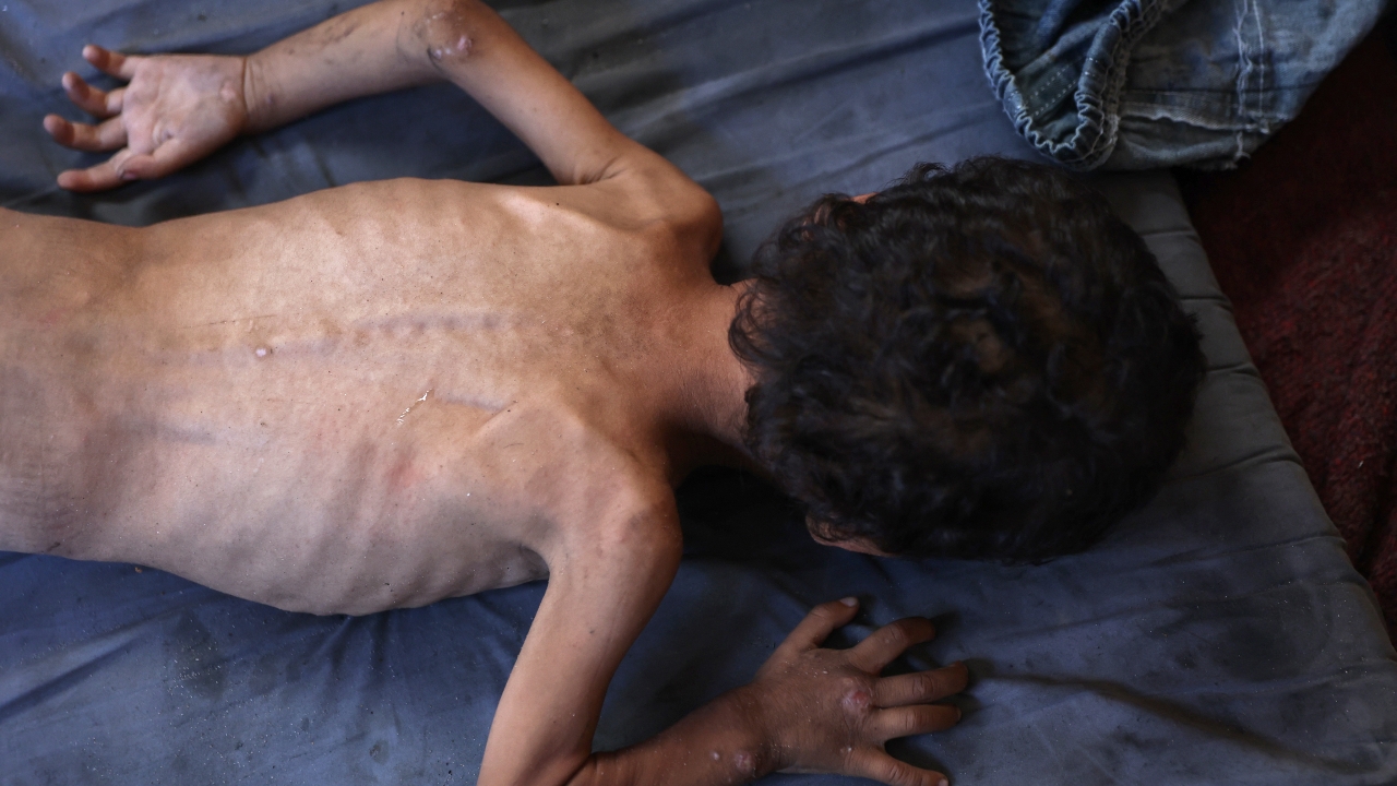 สลด เด็กชายปาเลสไตน์วัย 2 ขวบ เสียชีวิตเพราะขาดสารอาหารอย่างรุนแรง