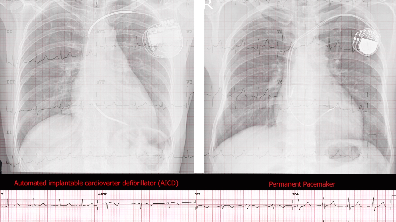 รัฐเทนเนสซี ประหารชีวิตนักโทษโดยไม่ปิดเครื่องกระตุ้นหัวใจ กลุ่มสิทธิฯ ชี้เป็นการทรมาน ผิดมนุษยธรรม
