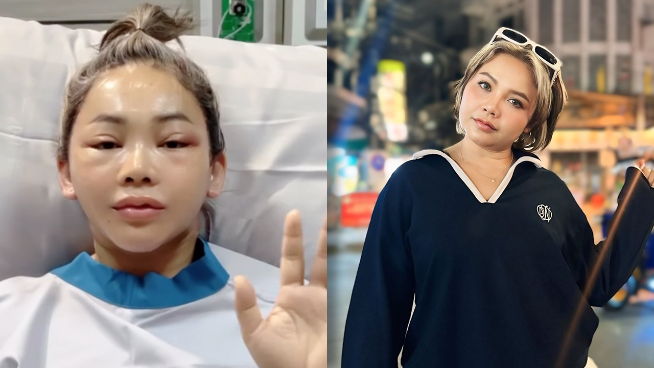 เปลี่ยนไปจนจำแทบไม่ได้ ตั๊กแตน ชลดา ขึ้นเขียงศัลยกรรมใบหน้า สวยจึ้งดูเด็กลงมาก