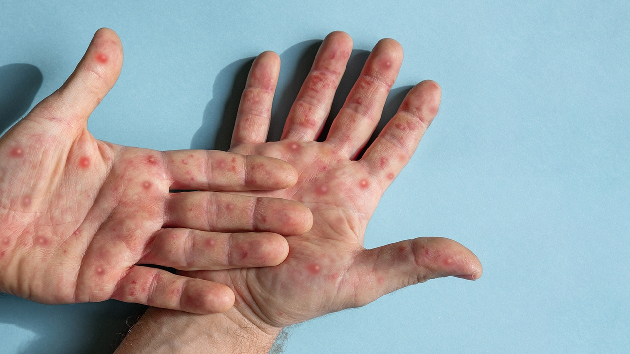 เตือนสถานการณ์โรค "ฝีดาษลิง" พบป่วยสะสม 40 คน