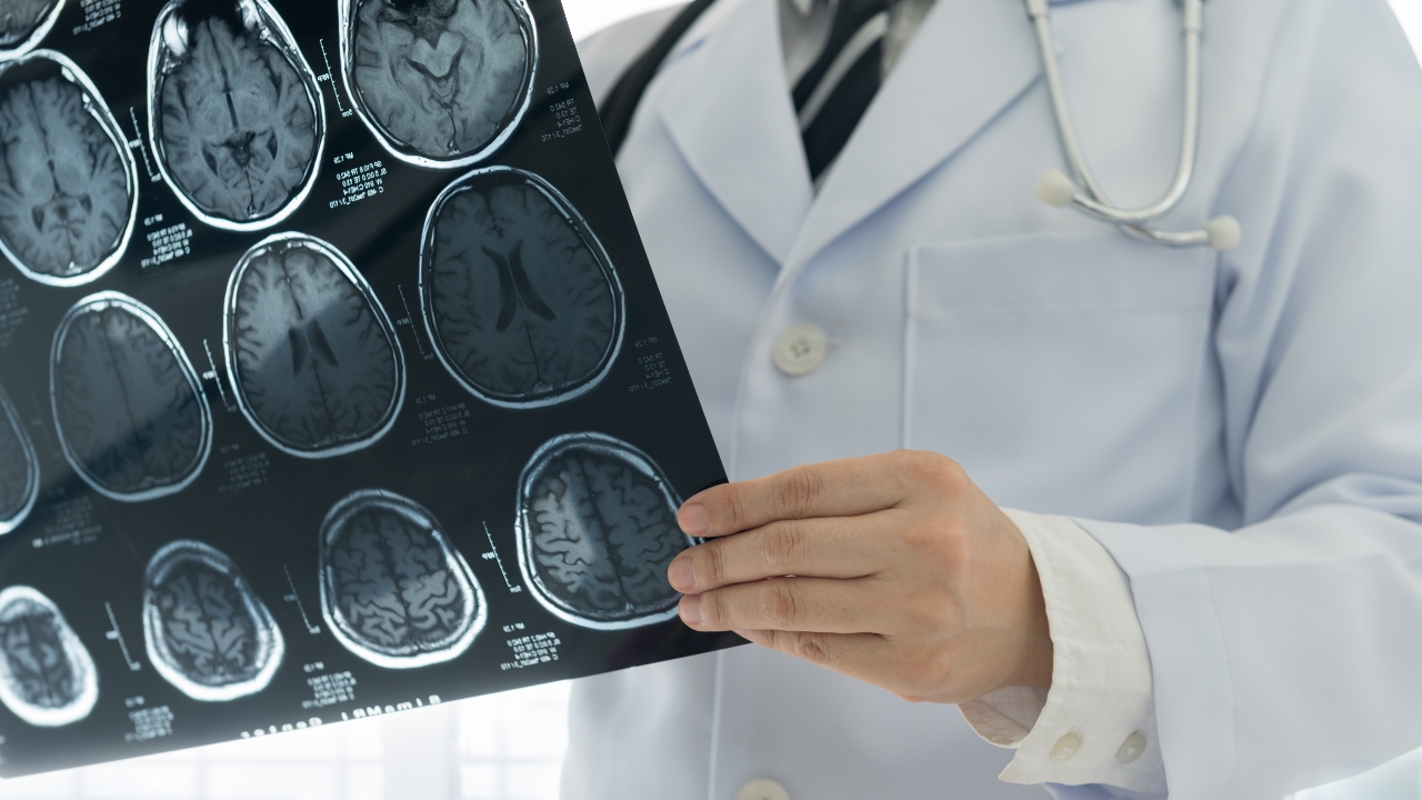 RAPID Software นวัตกรรมพลิกนาทีชีวิต ผู้ป่วย Stroke สมองขาดเลือด