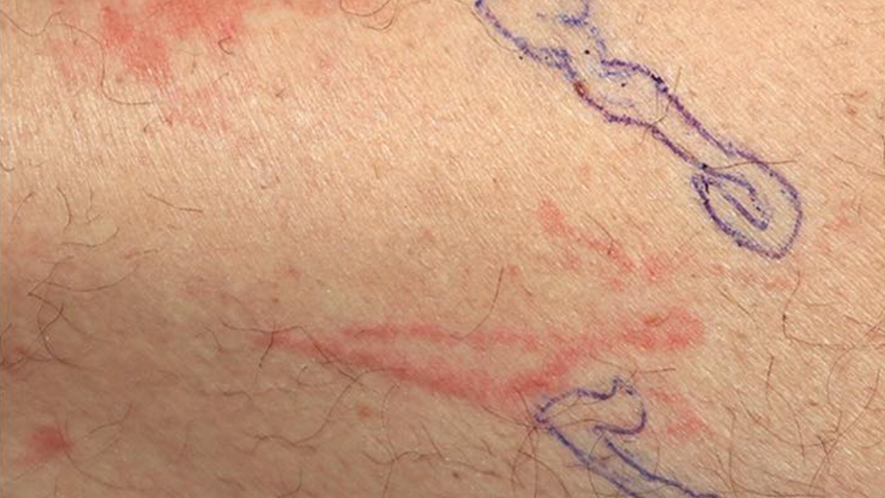 ชายวัย 64 มีผื่นแดง-ท้องเสีย รอยแดงทั่วตัว สุดท้ายพบเป็น "รอยไชพยาธิ"