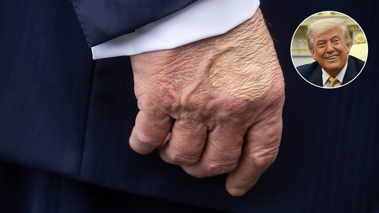 ทำเนียบขาวยืนยัน ทรัมป์ป่วยโรคหลอดเลือดดำ หลังมีคนเห็นอาการบวมที่ขาและรอยฟกช้ำที่มือ