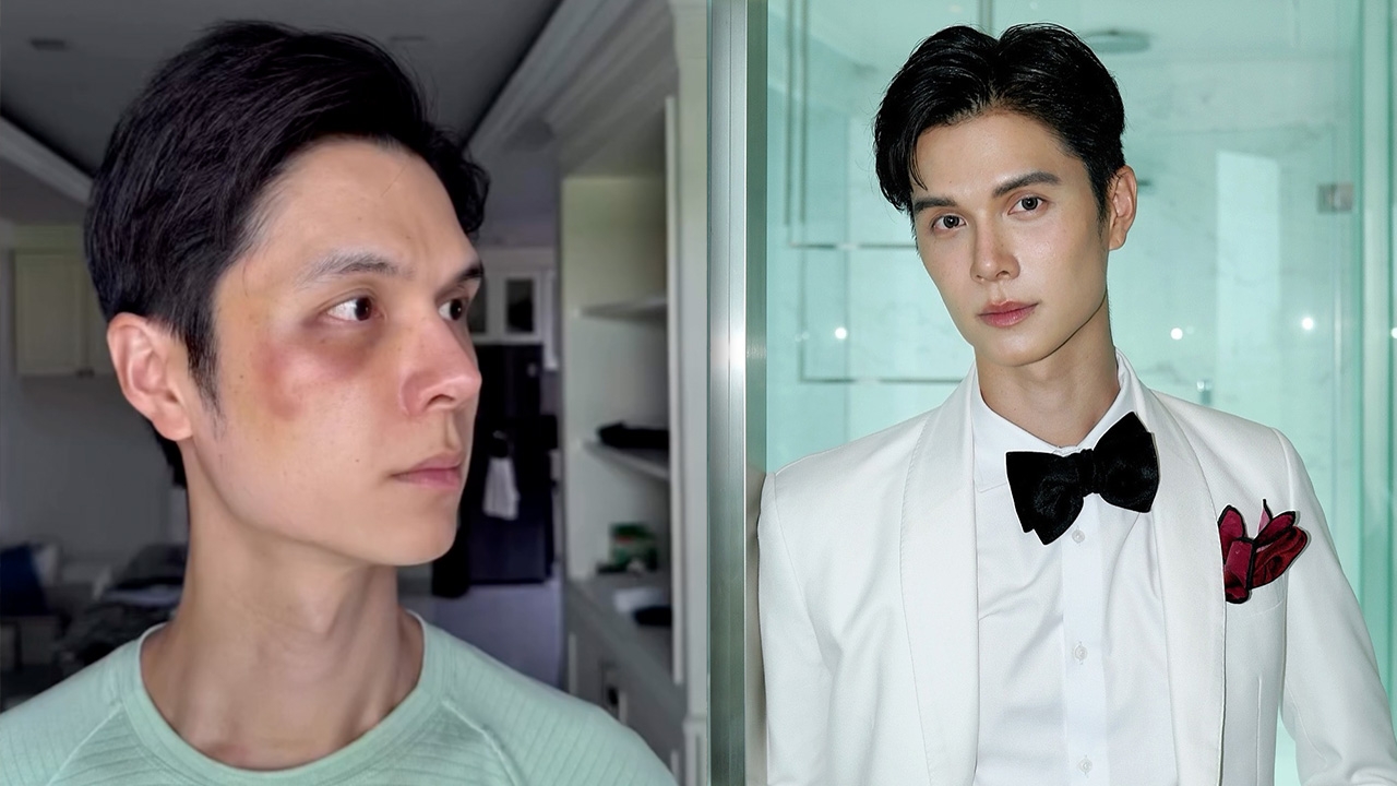 โยชิ นิมิต แชร์ประสบการณ์หน้าพัง พลาดแล้วแก้ยากมาก แนะเลือกหมอให้ดีๆ (คลิป)