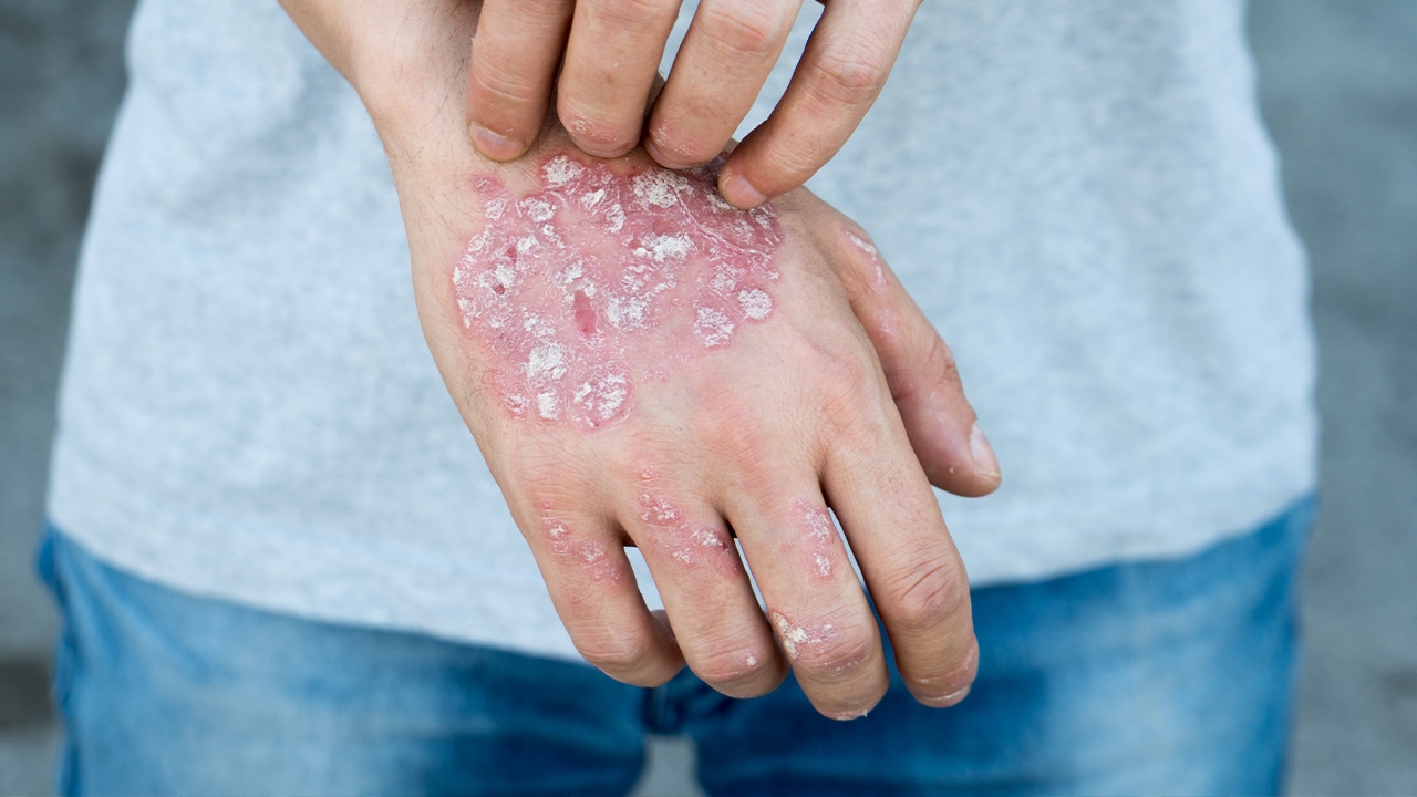 วงจรคันคะเยอ เอาแต่เกา เกาดีมั้ย? (ตอน 1)