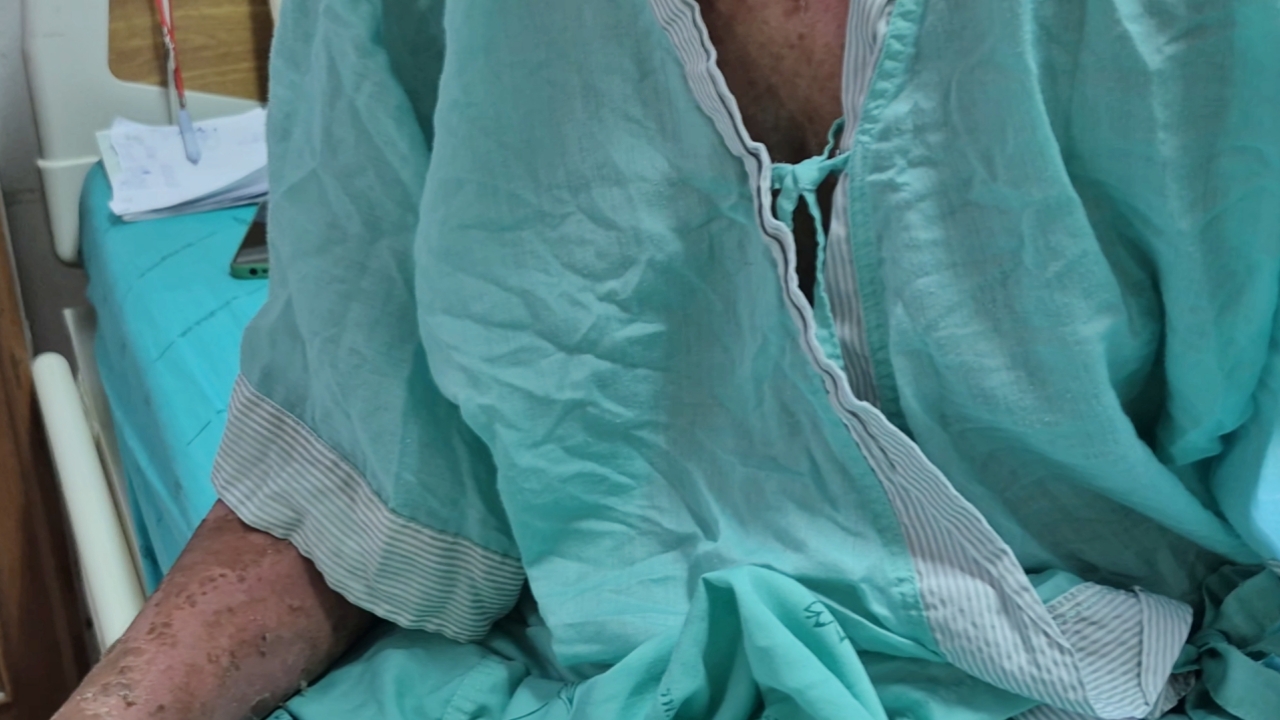 สาวเป็นงูสวัด ไปหาหมอพื้นบ้าน ท่องคาถาพ่นหมากพลู สุดท้ายทรุดหนัก