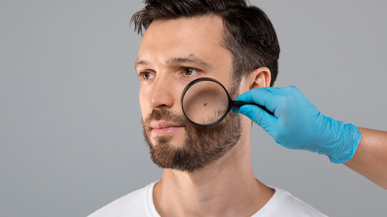 ไฝบนหน้าบอกอะไร เปิดความหมาย ทำนายนิสัย และโชคชะตา