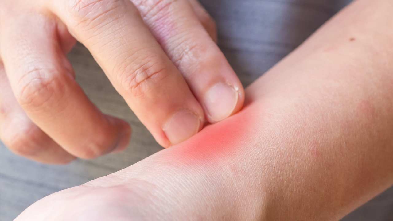 “พยาธิตัวจี๊ด” ชื่อฟังดูน่ากลัว เราจะติดเชื้อนี้ได้อย่างไร