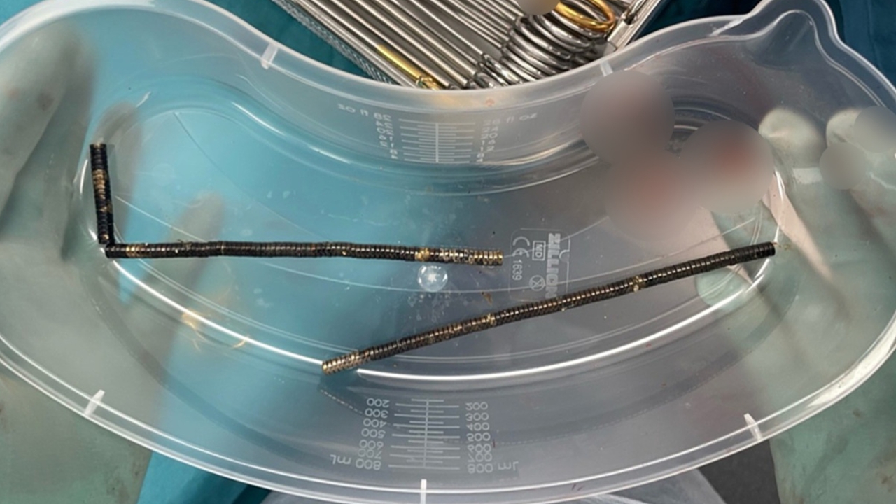 หมอนิวซีแลนด์ผ่าตัดเอา "แม่เหล็ก" กว่า 100 ชิ้น ออกจากลำไส้เด็ก หลังสั่งซื้อจาก Temu