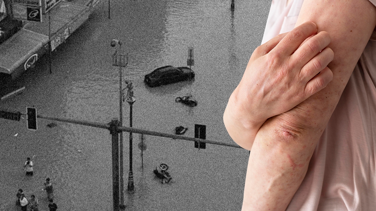 5 เคล็ดลับดูแลตัวเองช่วงน้ำท่วม ระวังโรคที่มากับน้ำ "ผิวหนัง-ยุงลายกัด"