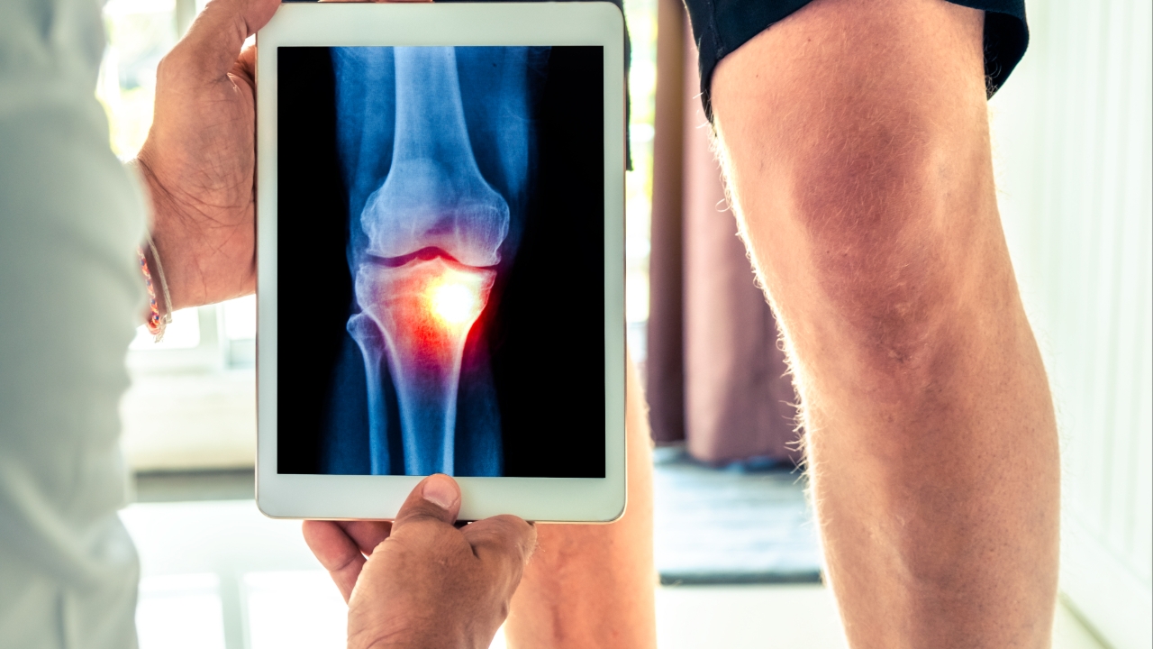 โรคข้อเข่าเสื่อม วิธีรักษามีแบบไหนบ้าง รวมวิธีรักษาเข่าเสื่อมให้กลับมาดีขึ้น