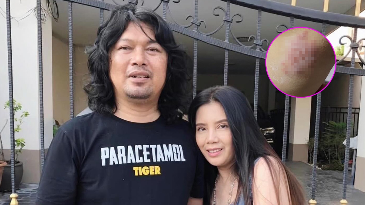 คนเป็นห่วง กานต์ วิภากร เผยภาพผื่นที่แขน เสก โลโซ คุณหมอเข้ามาตอบพร้อมแนะวิธีรักษา