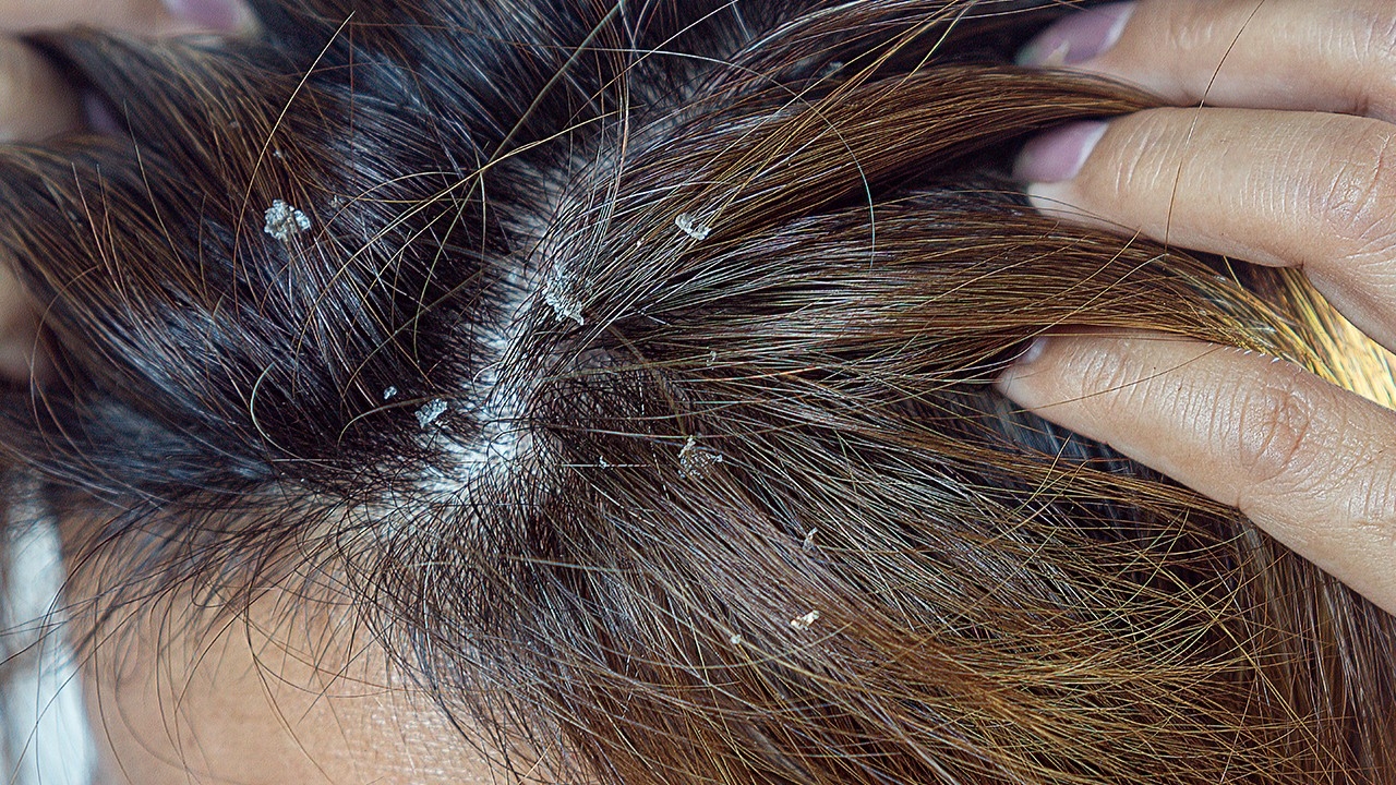 Say Goodbye to Snowy Shoulders: 5 Effective Ways to Get Rid of Dandruff and Restore Scalp Confidence