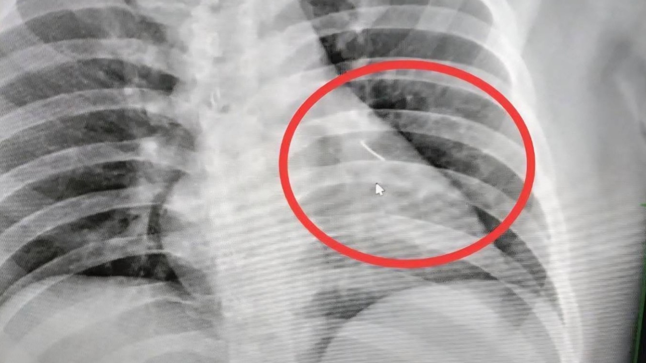 หนุ่มวัย 27 เจ็บหน้าอกไม่ทราบสาเหตุ เอ็กซ์เรย์พบเข็มเย็บผ้าเสียบมิดเฉียดหัวใจ