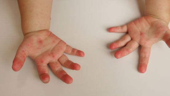 รู้จักเชื้อ "EV71" ตัวร้ายในโรคมือเท้าปาก เสี่ยงสมองอักเสบ-หัวใจวาย เช็กวิธีป้องกันที่นี่