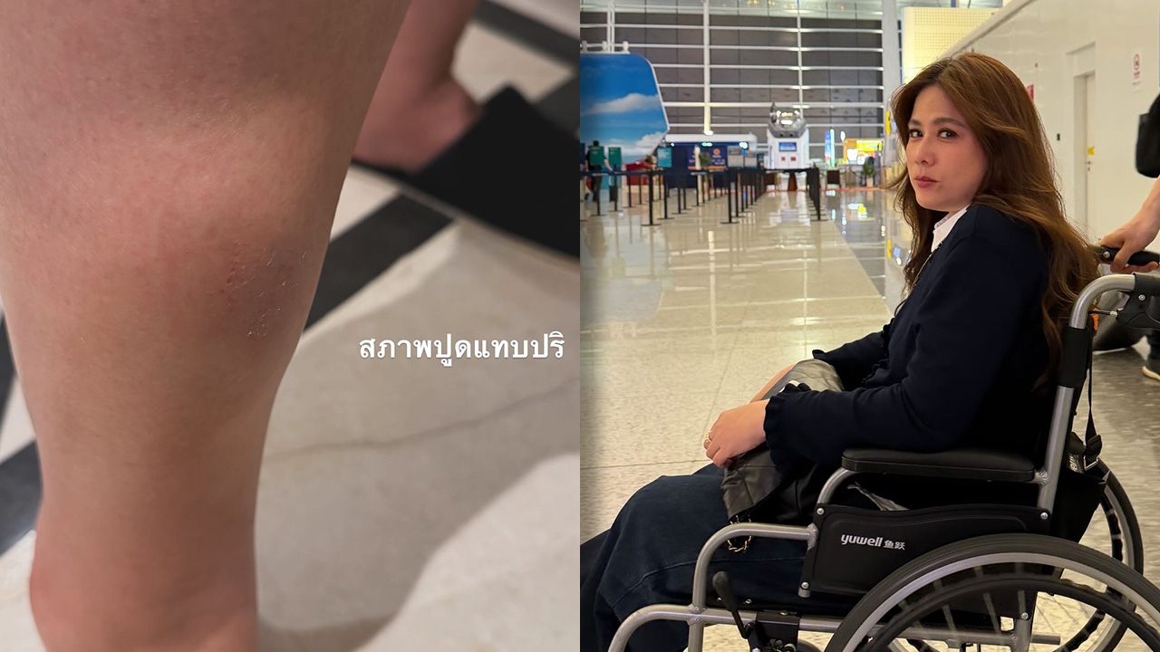  ติ๊ก กัญญารัตน์ เผยภาพขาบวมเหตุเกิดตกบันไดทริปเที่ยว 