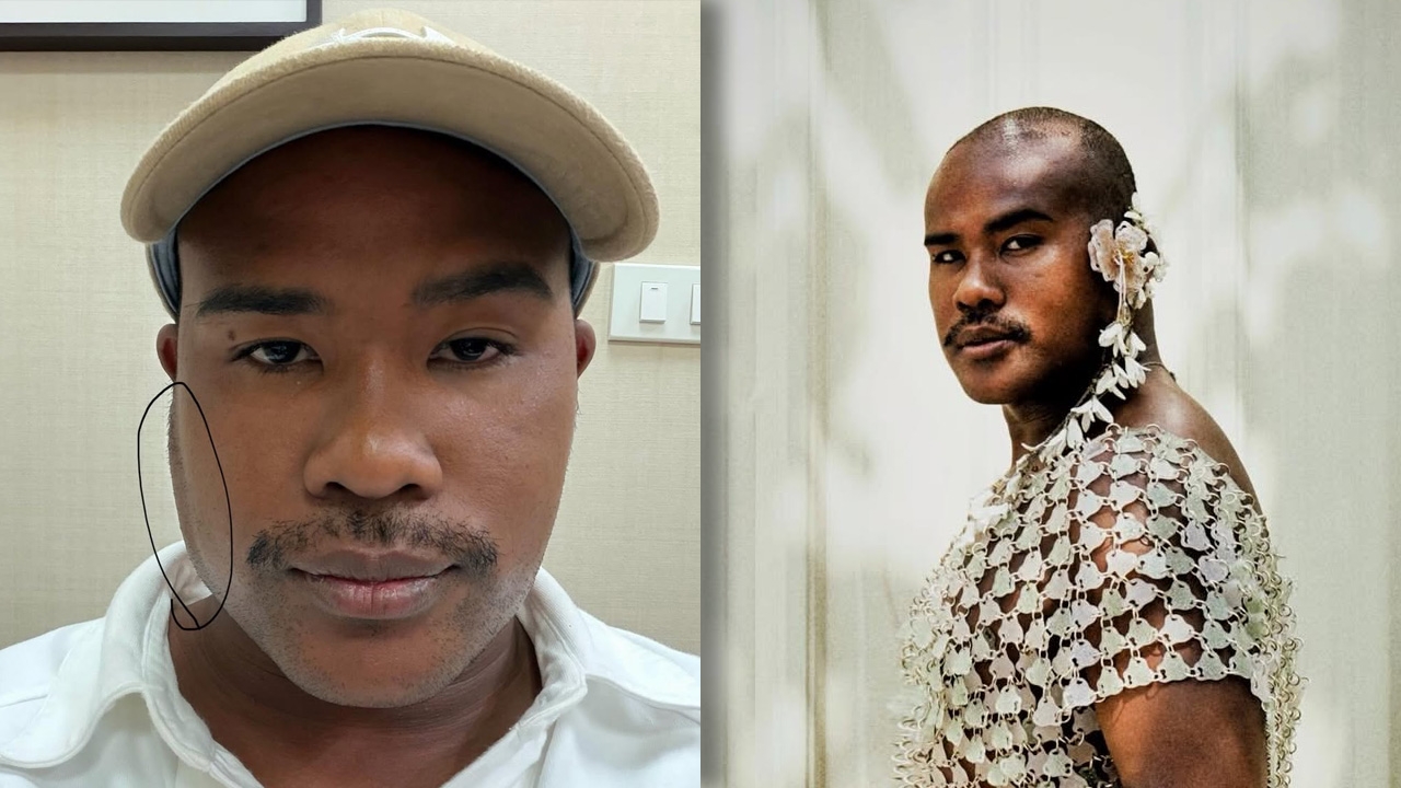 รัศมีแข โพสต์ภาพหน้าเบี้ยวบริเวณฝั่งขวา พร้อมเผยสาเหตุ แฟนๆ ส่งกำลังใจ