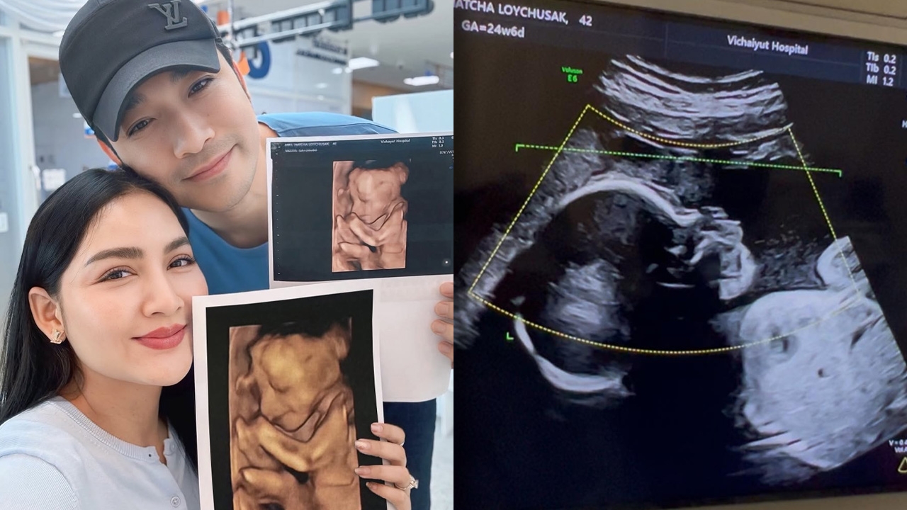 เจมส์-ครูก้อย อวดภาพอัลตราซาวนด์ น้องมีเมตตา ฉายแววน่ารัก จมูกโด่งตั้งแต่อยู่ในท้อง