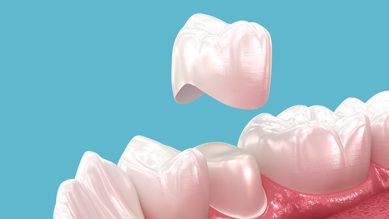 การดูแลครอบฟัน  และสัญญาณที่ต้องเปลี่ยน