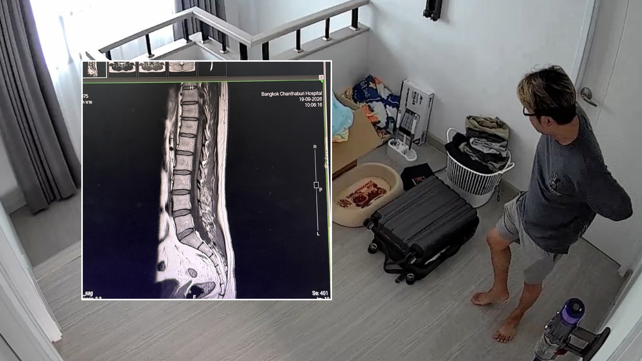 อุทาหรณ์ หนุ่ม “จาม” แรงทีเดียว ทำไร้เรี่ยวแรง ทรุดกับพื้น MRI พบ “หมอนรองกระดูกปริ”