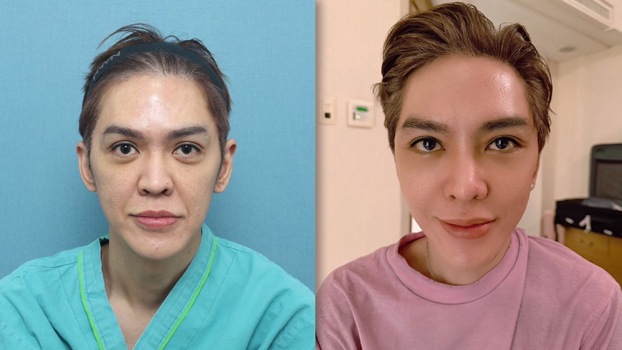“ดัง พันกร” ภูมิใจหน้าใหม่ เป็นเวอร์ชันที่ดีที่สุด ลั่นตัดสินใจถูกที่ศัลยกรรม